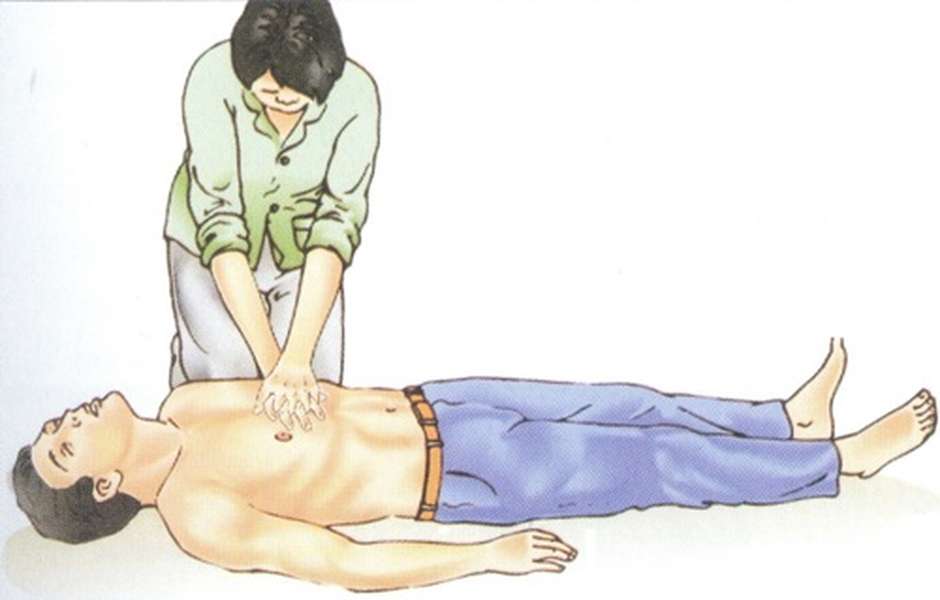 Cardiac arrest - Hình ảnh minh họa